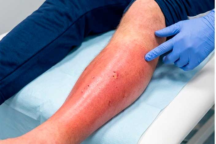 Celulitis infecciosa: qué es, causas, síntomas, tratamiento, prevención