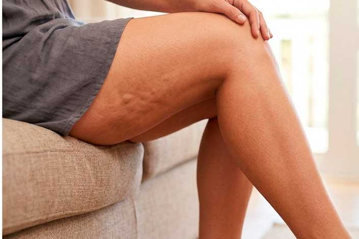 Celulitis infecciosa tratamiento